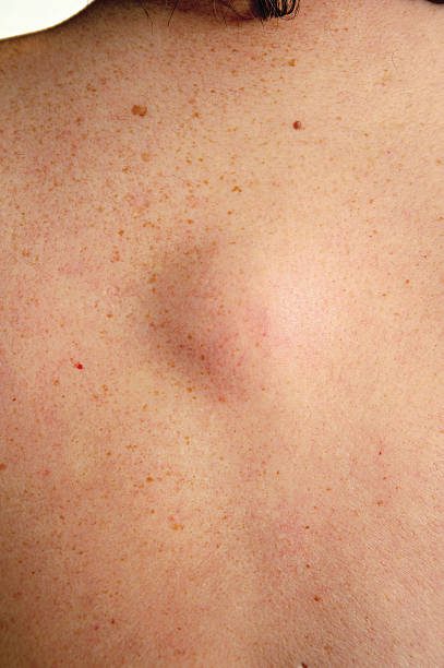 Lipoma en la espalda: ¿es realmente inofensivo?